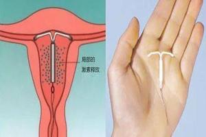 晋江上环需要复查吗(上环检查费用大概多少)
