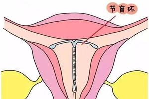 晋江上环对身体的影响(上环对生育有影响吗)