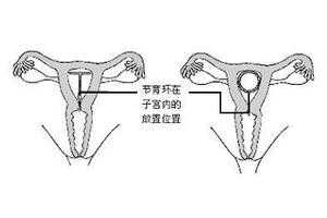 晋江人流多久能上环(做人流多长时间可以上节育环)