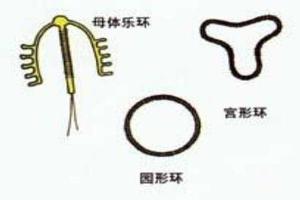 晋江上环扩宫(上环扩宫器图片)