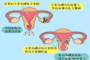 晋江上环后肚子疼怎么办(上环后肚子痛怎么缓解方法)