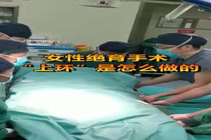 晋江上环可以管几年(上环一般能上多少年就要拿掉)
