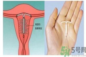 晋江上环会疼么(上环会不会痛,要很久吗)
