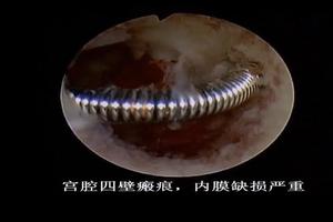 晋江t型环取环疼吗(t型环取环过程)