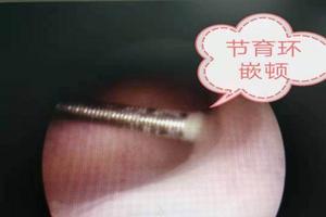 晋江上环后腰疼(上环后腰疼怎么治疗)
