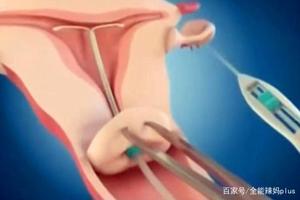 晋江上环是怎么避孕的(上环是如何达到避孕效果的)