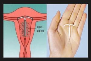 晋江上环要准备什么(上环需要些什么资料)