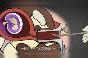 晋江引产手术的过程(引产手术步骤大全)
