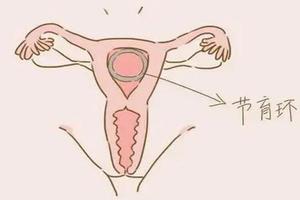 晋江不上环如何避孕(不上环还有什么办法更方便避孕)